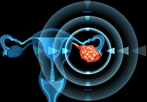 Ovarian Cancer