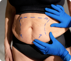 Fat Removal