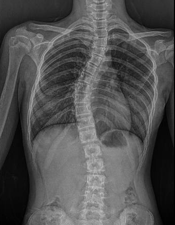 Scoliosis Beyond the Spine: How It Impacts Breathing, Digestion, and Mental Health.  (Dr Tan Jin Aun and Dr Deepak)