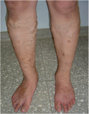 Surgery for Lower Limb Varicose Veins