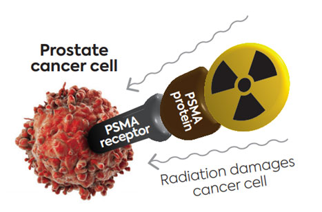 Lutetium-177 PSMA therapy